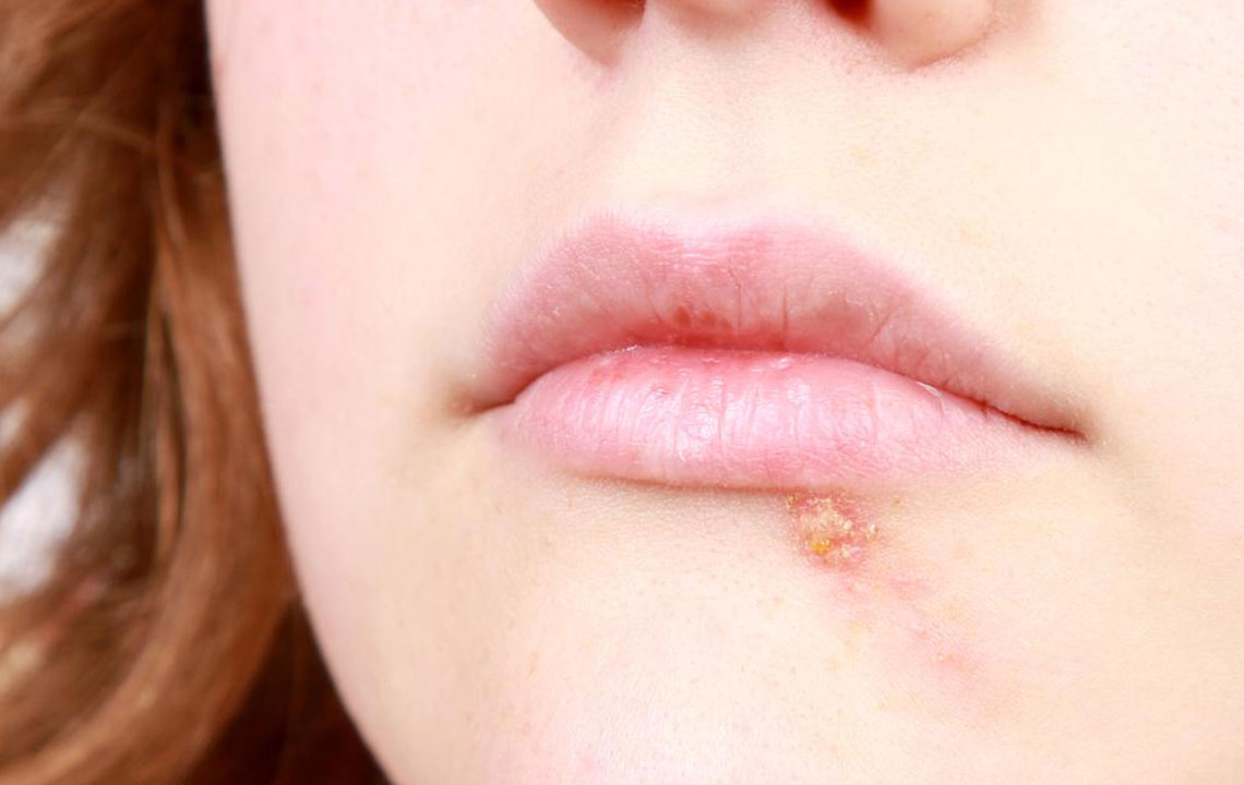 Effective Natural Remedies to Relieve Cold Sores and Accelerate Healing