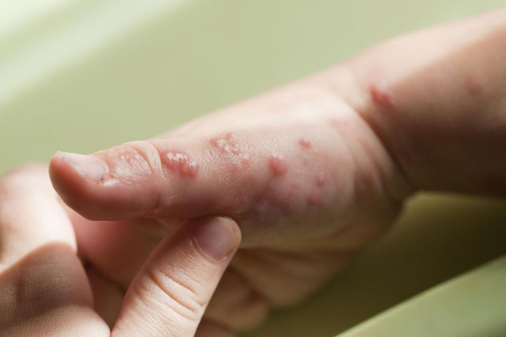 Understanding Shingles and Its Impact on Nerve Health