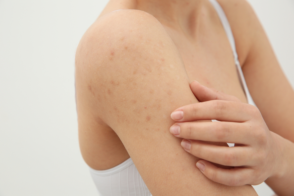 Comprehensive Overview of HIV-Related Skin Rashes: Causes, Symptoms, and Management