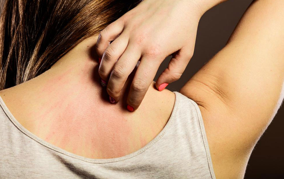 Essential Facts About Scabies You Need to Know