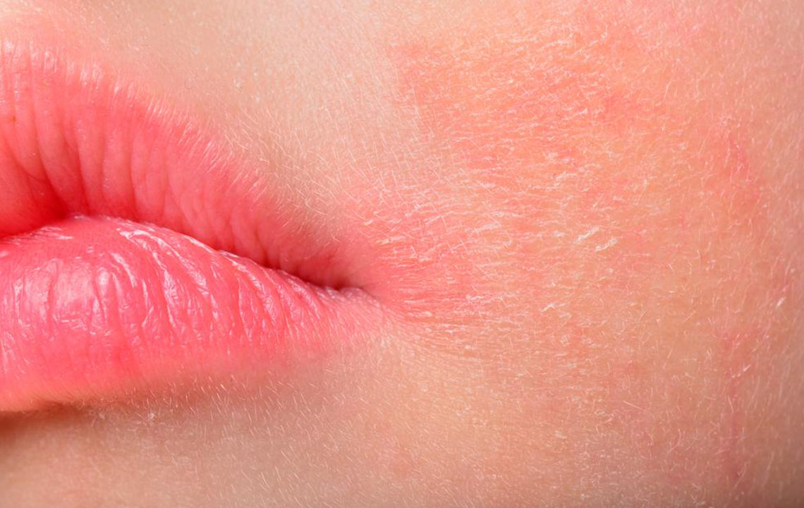 Understanding Atopic Dermatitis: Causes, Symptoms, and Management