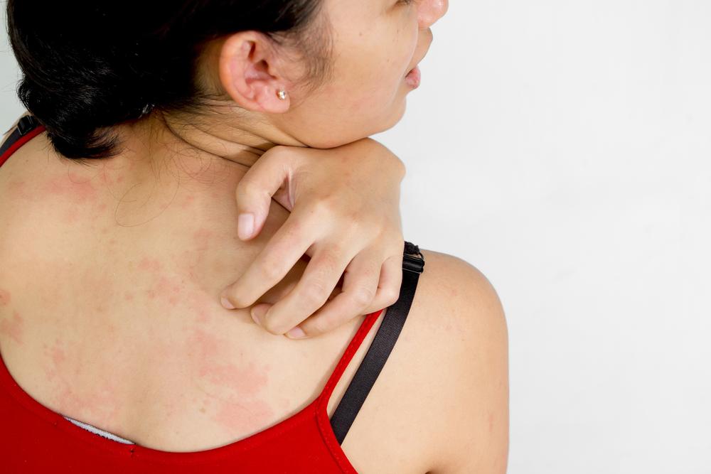 Understanding Eczema: Causes, Symptoms, and Management Techniques