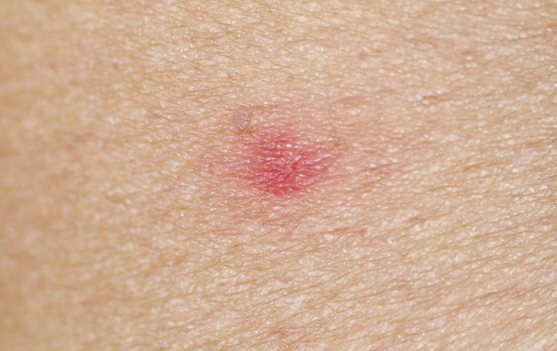 Guide to Recognizing and Differentiating Bug Bites