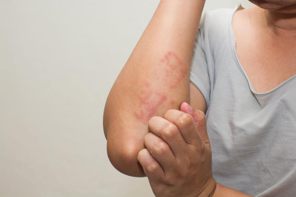 Comprehensive Guide to Managing Atopic Dermatitis Effectively