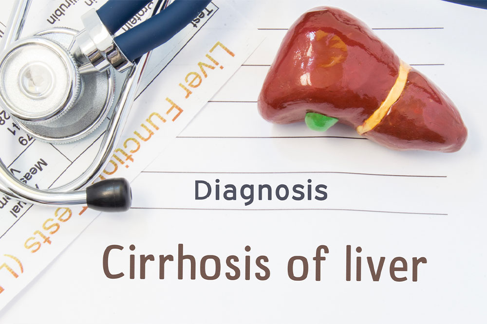 Comprehensive Guide to Liver Cirrhosis: Causes, Stages, Symptoms, and Prevention