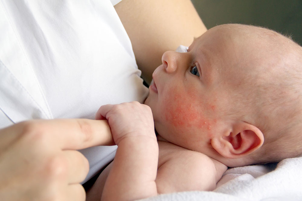 Essential Tips to Prevent Common Infant Skin Problems