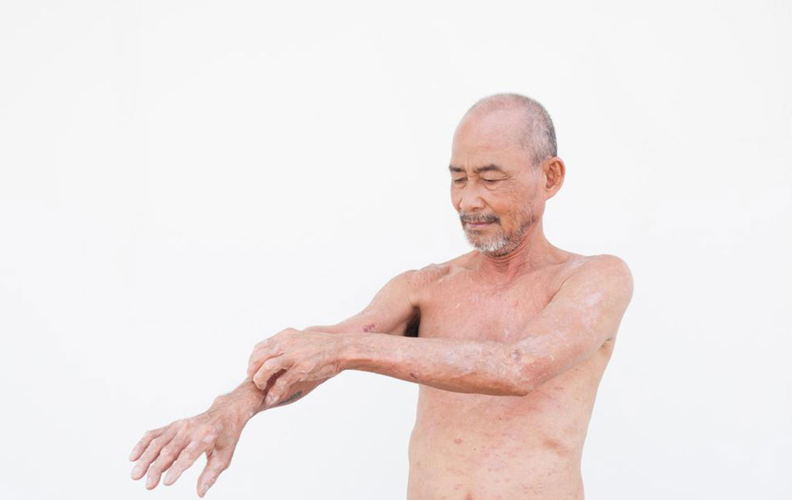 Comprehensive Guide to Managing Eczema