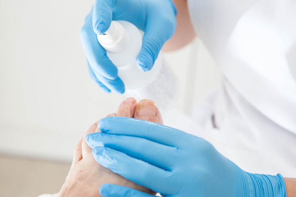 Effective Strategies for Treating and Managing Toenail Fungal Infections