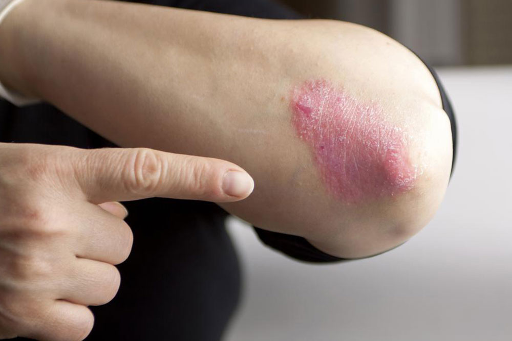 Understanding Chronic Psoriasis: Types and Management Strategies