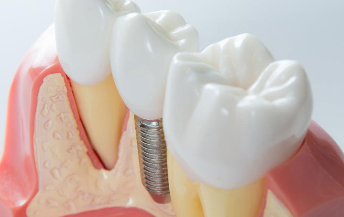 Comprehensive Guide to Caring for Dental Implants in Seniors: Tips for Long-Term Success