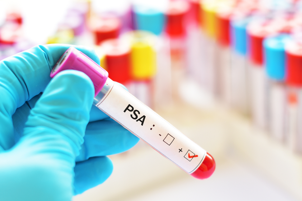 Understanding PSA Levels and Strategies to Reduce Them