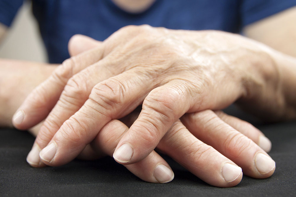Understanding Arthritis: Stages, Diagnosis, and Prevention