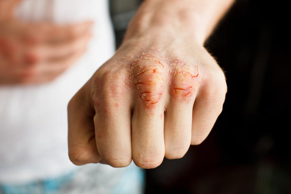 Effective Strategies to Control Psoriasis Flare-Ups