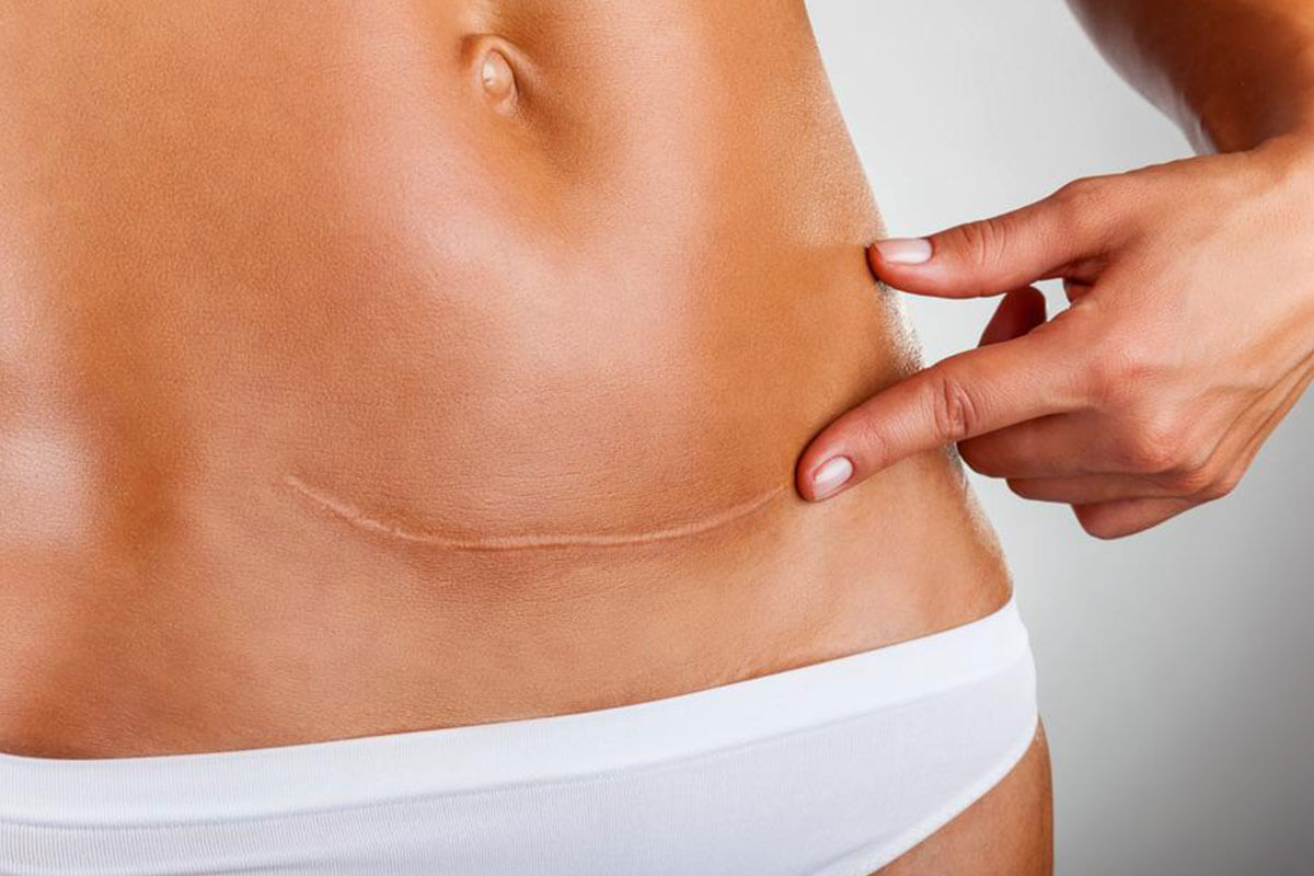 Recognize These 5 Early Warning Signs of Ovarian Cancer