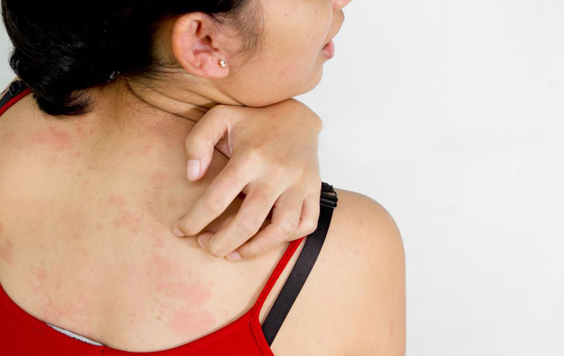 Comprehensive Guide to Persistent Itchy Skin: Causes, Remedies, and When to Seek Medical Help