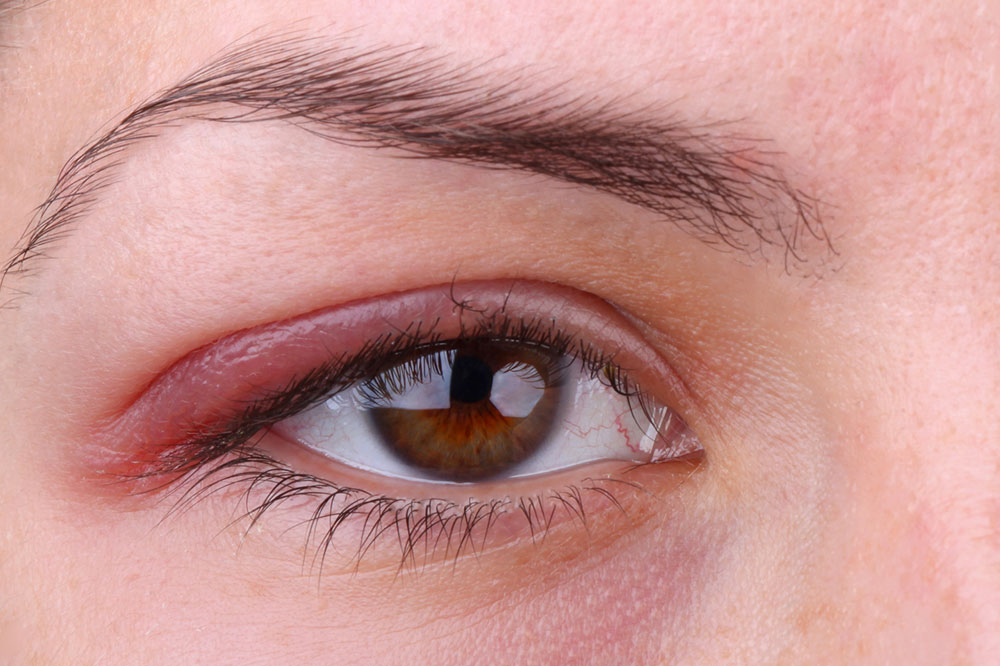 Understanding the Top 3 Common Eye Disorders and Their Impact