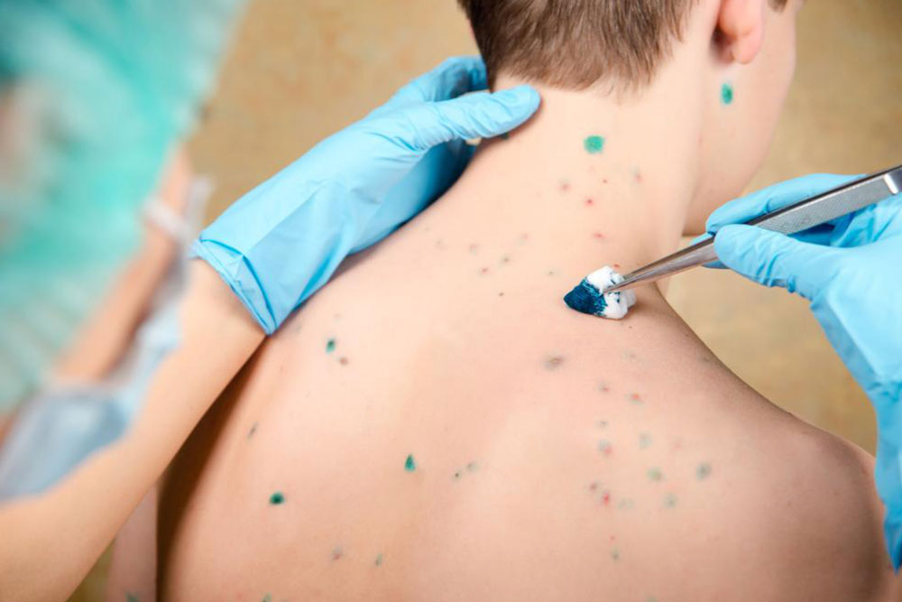 Comprehensive Guide to Skin Rashes and Effective Treatment Options
