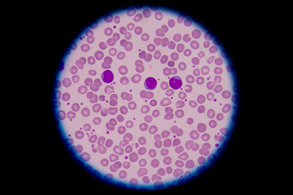 Ultimate Guide to Blood Disorders: Symptoms, Causes, Diagnosis, and Treatment