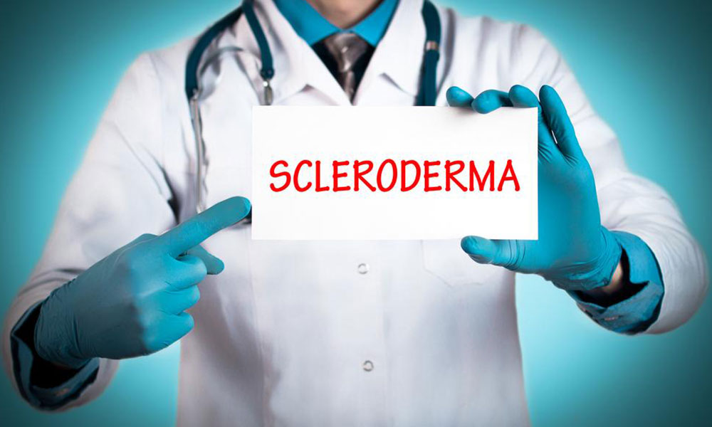 Early Intervention Strategies for Scleroderma Symptoms