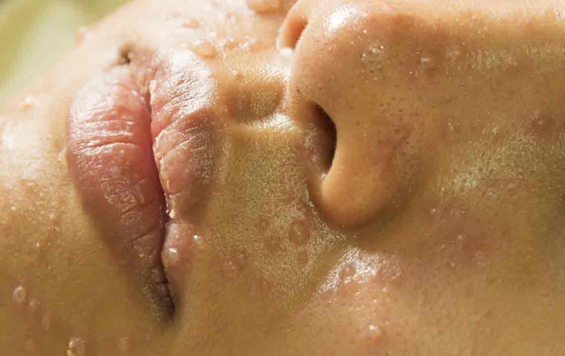 Natural Remedies and Treatments for Managing Rosacea