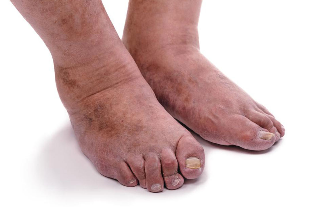 Key Insights into Rheumatoid Arthritis Symptoms and Management