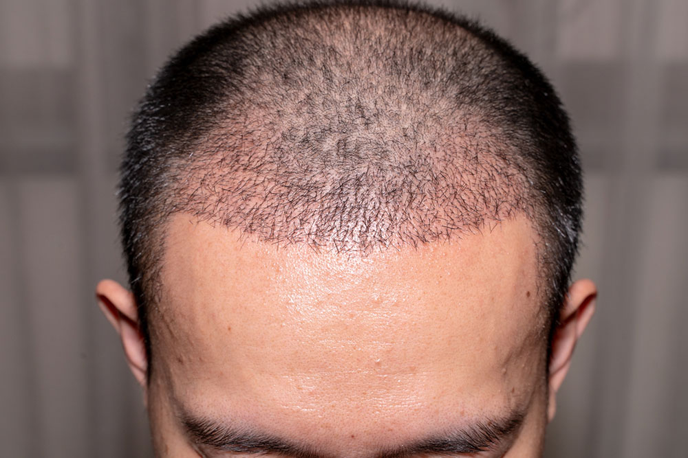 Comprehensive Guide to Hair Restoration Surgery: Techniques, Benefits, and Expert Selection