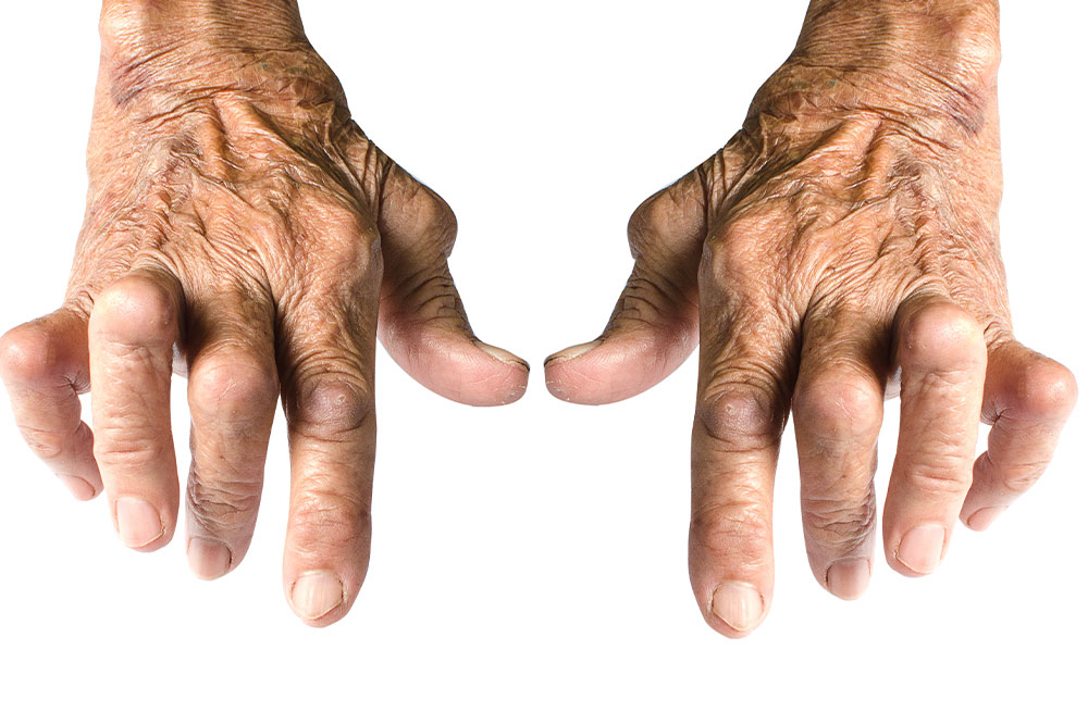 Essential Strategies for Effective Management of Rheumatoid Arthritis