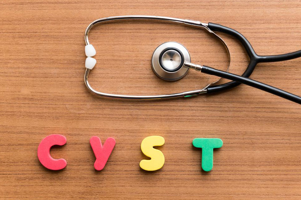 Effective Treatments for Sebaceous Cysts