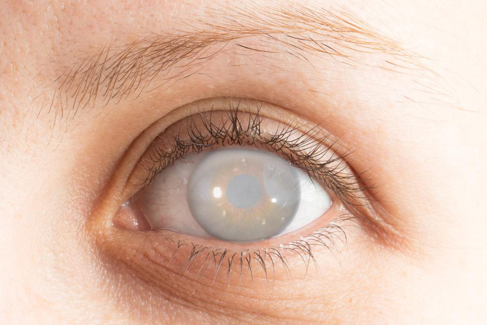 Essential Insights into Cataracts and Their Surgical Treatment