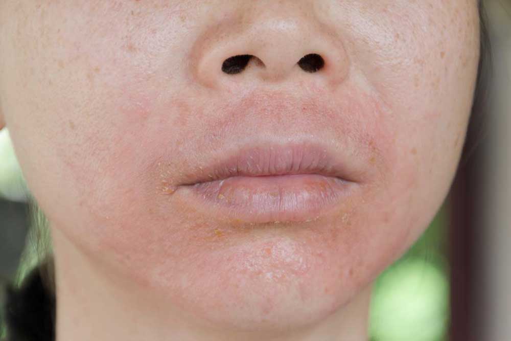 Comprehensive Guide to Managing Lupus-Induced Skin Symptoms Effectively