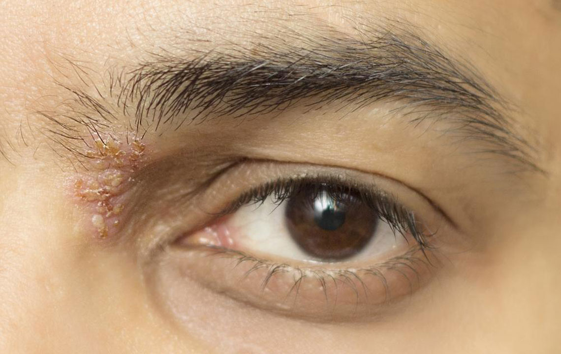 Effective Options to Alleviate Shingles Nerve Discomfort