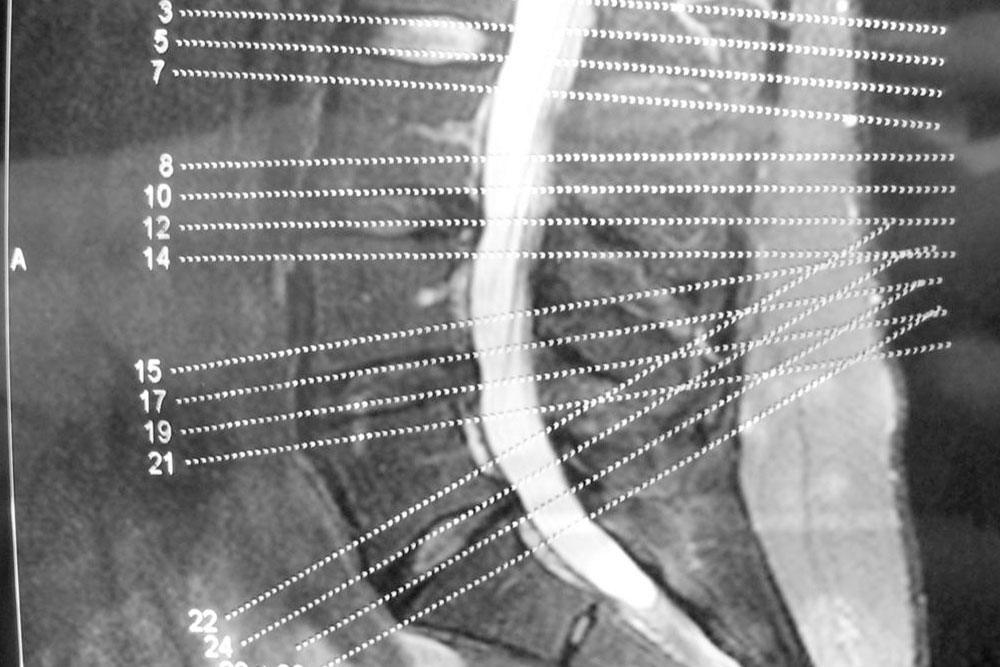 Understanding Degenerative Spine Conditions: Disc and Joint Diseases Explained