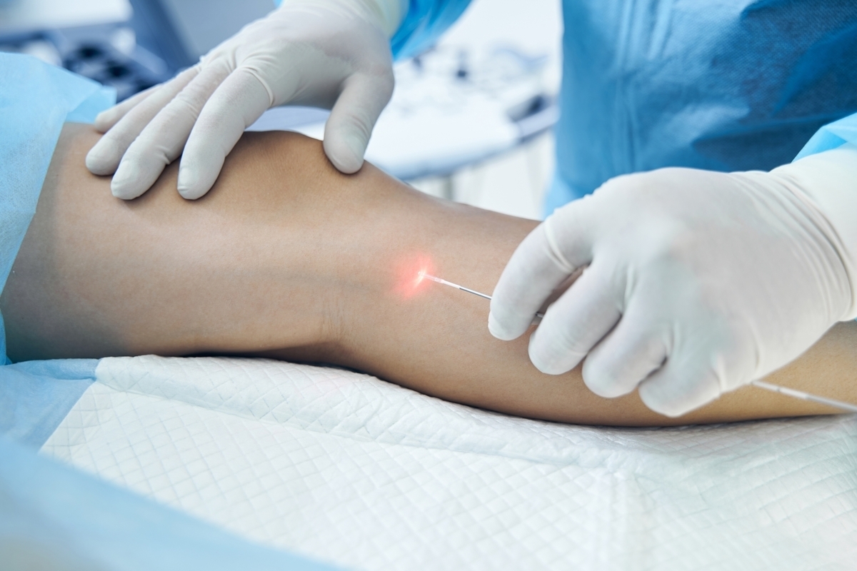 Comprehensive Guide to Varicose Vein Experts: Treatments and Patient Support