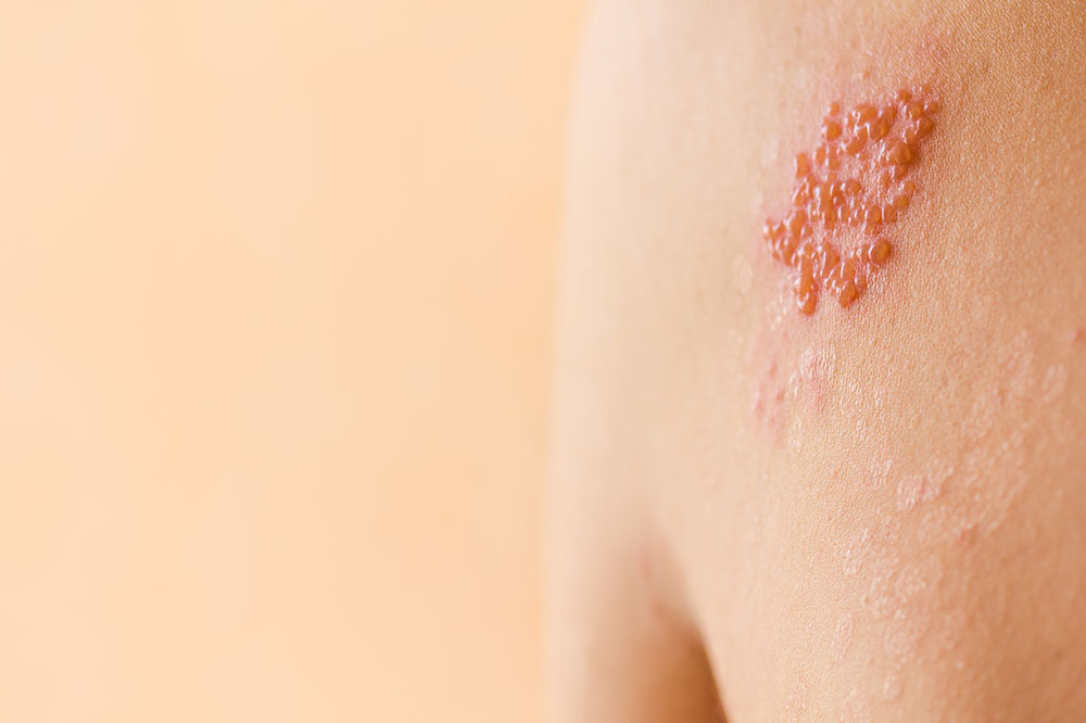Understanding Shingles: Symptoms and Causes