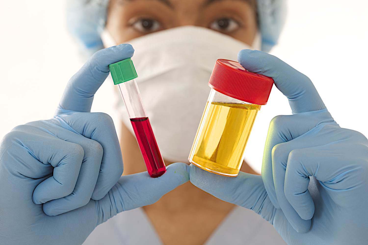 Understanding Hematuria: Blood in Urine Explained