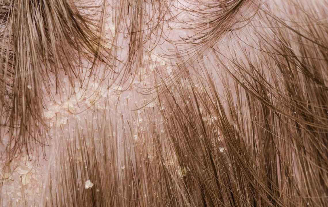 Understanding Scalp Psoriasis: Causes and Treatments