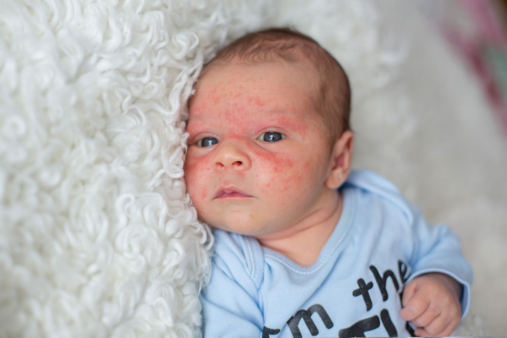 Understanding How Infant Eczema Evolves with Age and Steroid Usage