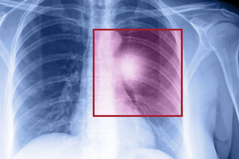 Understanding Lung Cancer: Types, Symptoms, and Causes