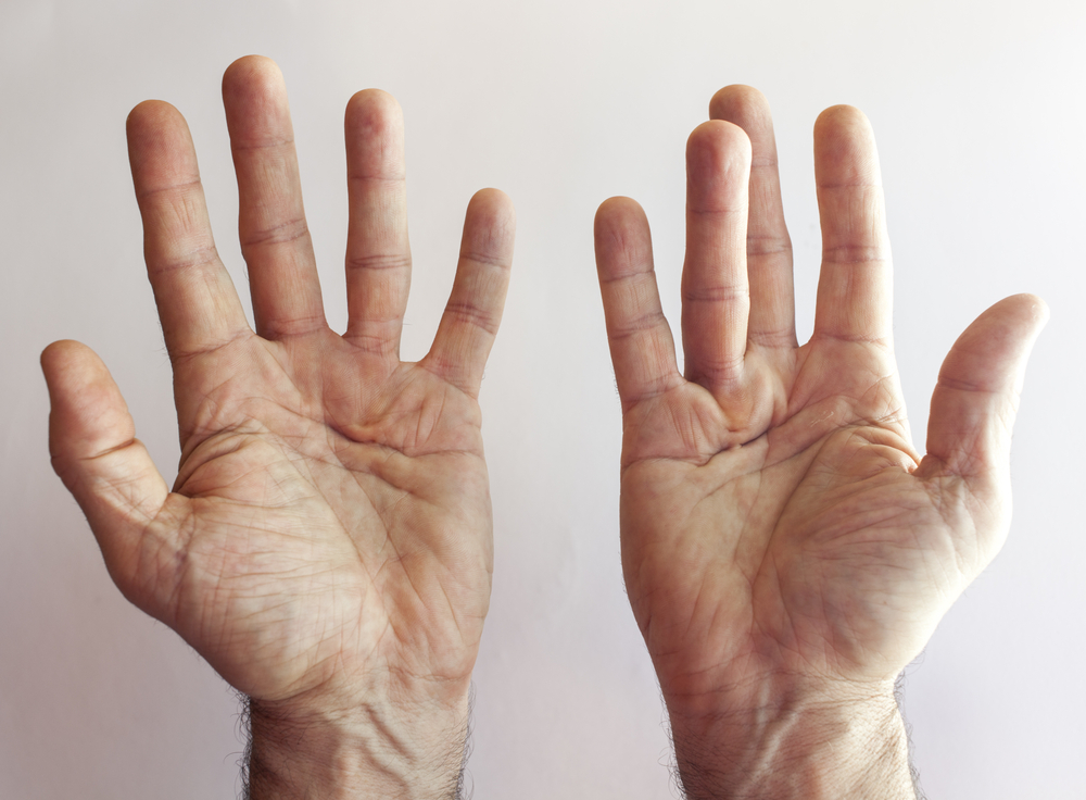 Understanding Dupuytren’s Contracture: Symptoms and Treatment Options