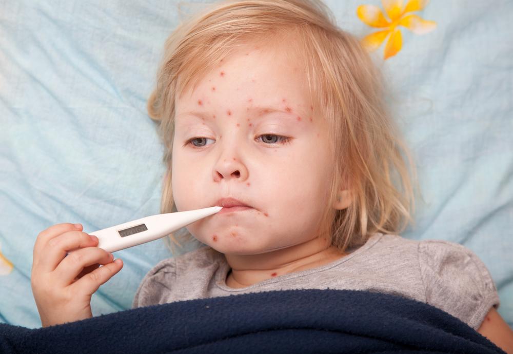 Understanding Measles: Causes, Symptoms, and Management
