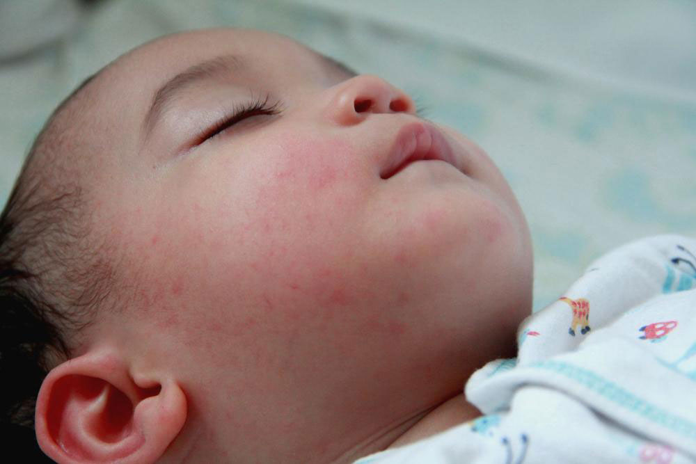 Recognizing Childhood Eczema: Key Symptoms and Management Tips