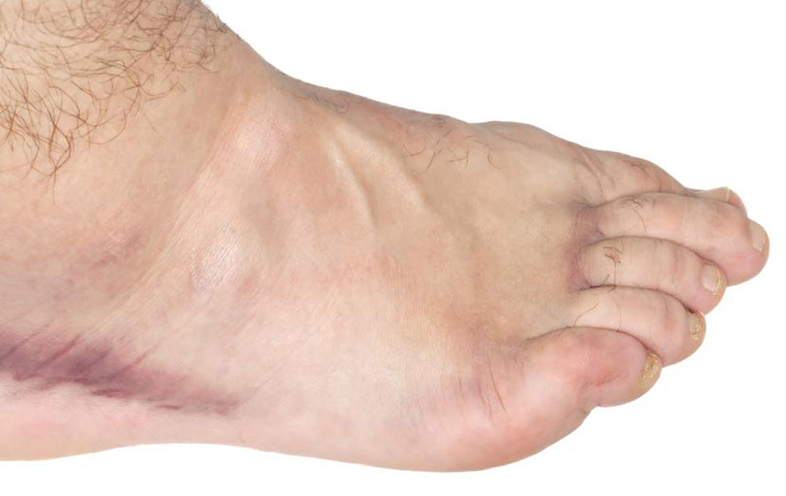 Effective Exercises to Ease Swollen Ankles