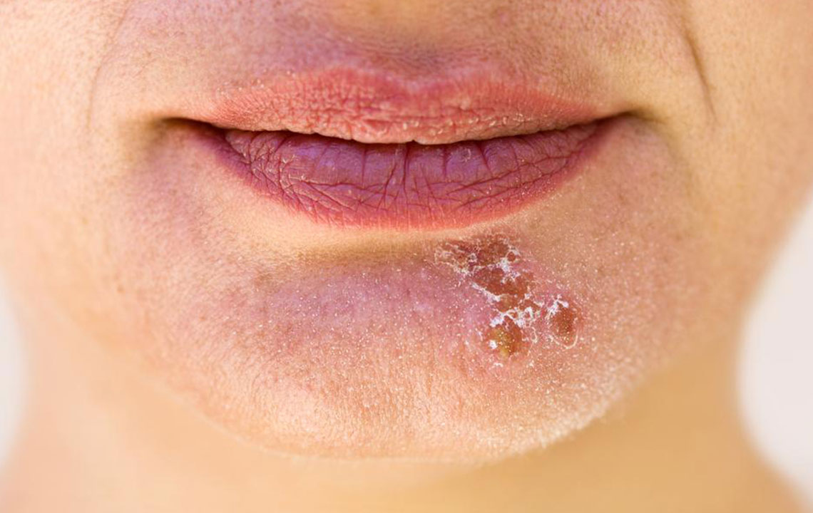 Comprehensive Guide to Natural Cold Sore Remedies: Top Essential Oils for Fast Relief