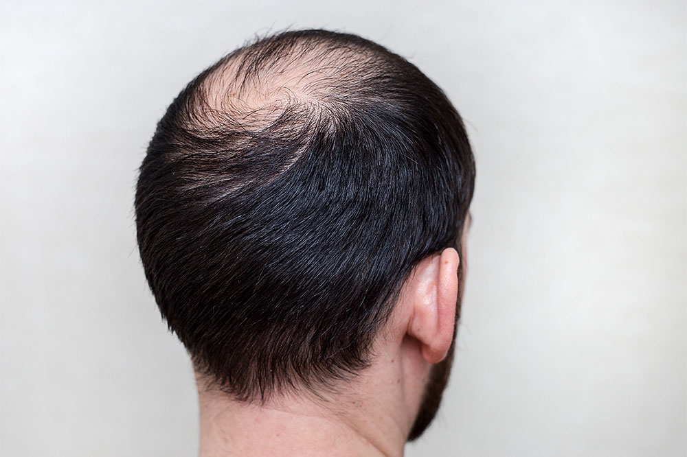 Comprehensive Guide to Male Hair Thinning: Causes, Stages, Detection, and Prevention Strategies