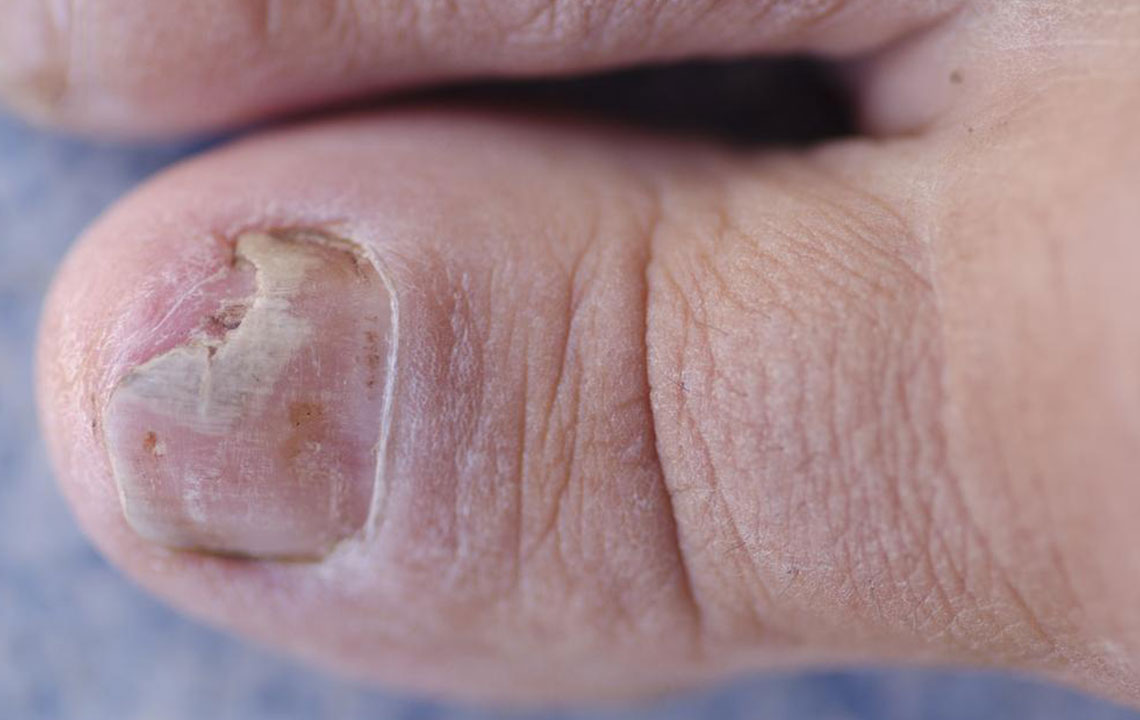 Natural and Medical Strategies for Combatting Toenail Fungus