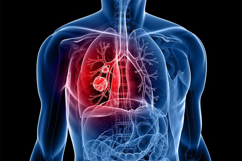 Top 5 U.S. Cities with the Highest Lung Cancer Rates and Contributing Factors