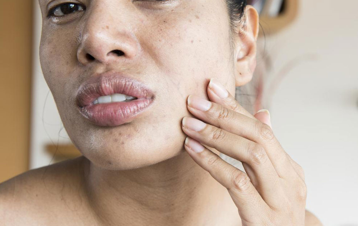 Key Signs and Symptoms of Lupus in Women You Should Recognize