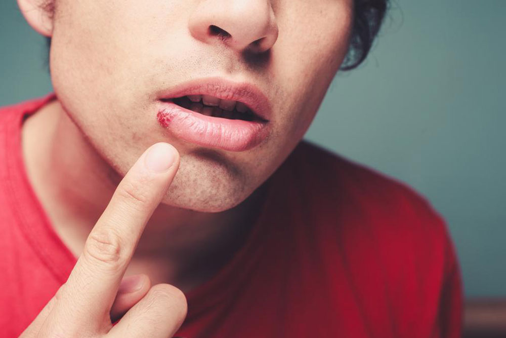 Essential FAQs About Cold Sores and Their Remedies