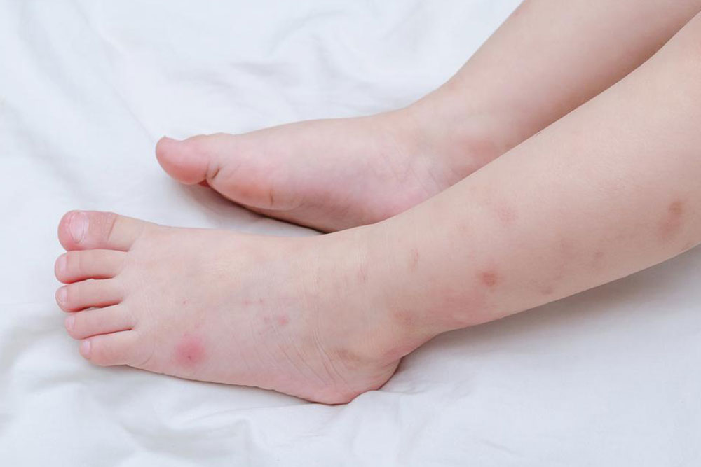 Quick Guide to Identifying Common Insect Bites