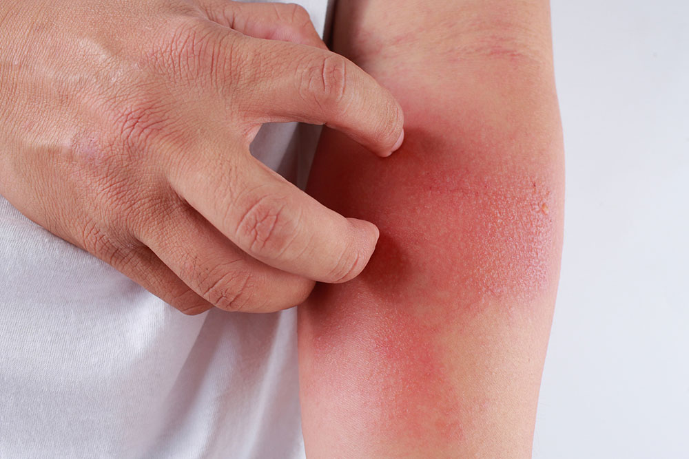 Natural Home Strategies to Ease Eczema Symptoms